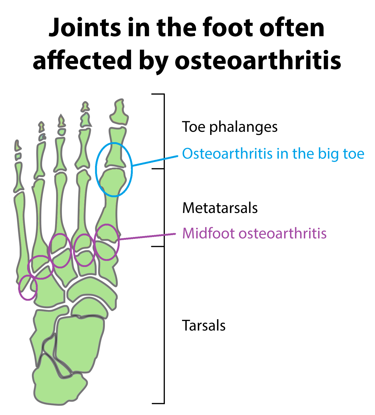 Osteoarthritis In The Ankle And Foot Buxton Osteopathy Clinic