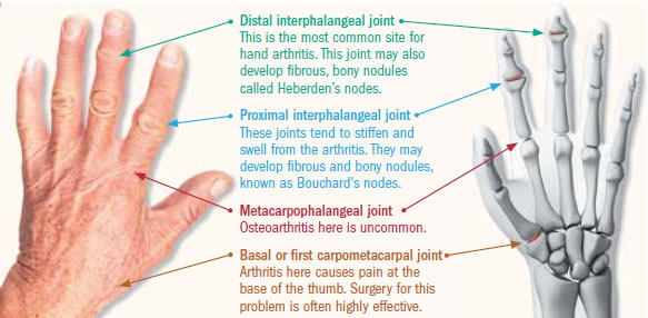 Osteoarthritis And Body Injuries Of The Hand