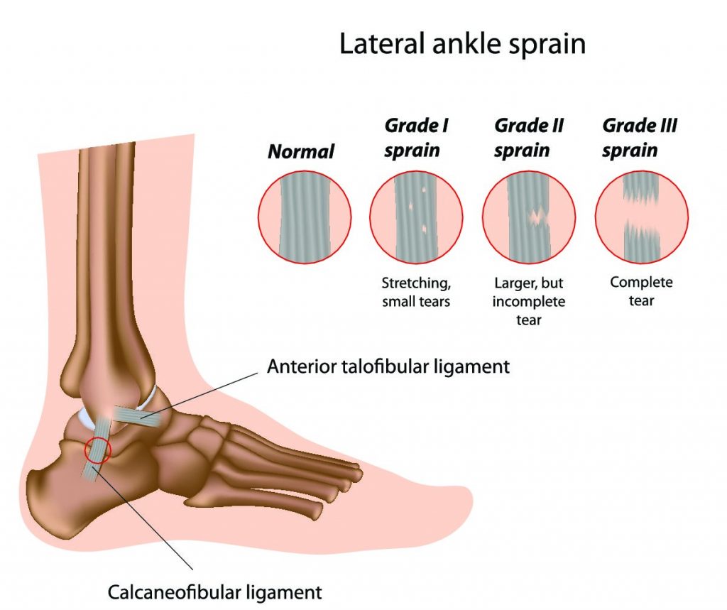Ankle Sprains - The Buxton Osteopathy Clinic